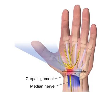 Stupid Medicine, Part 2: Carpal Tunnel Syndrome