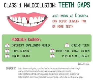 What is Malocclusion of the Teeth and How to Treat It