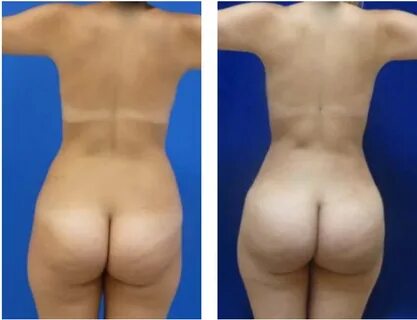 Brazilian Buttock Lift Via Fat Transfer By Dr. Moises Salama