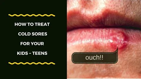 How Parents Can Treat Cold Sores For Their Kids -Teens - You