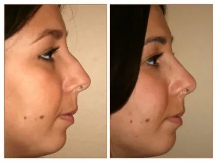 Rhinoplasty Nose Job Picture Gallery CHRISTOPHER T. JOHNSON,