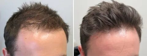 Propecia Rogaine Before After Photos Bernstein Medical
