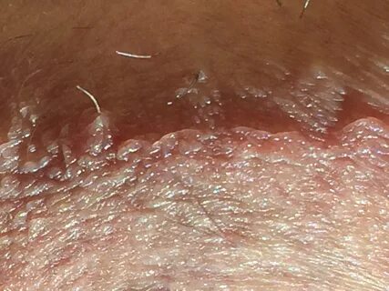 Penile Ingrown Hair Pictures - Pin on Make-up & Beauty docaz