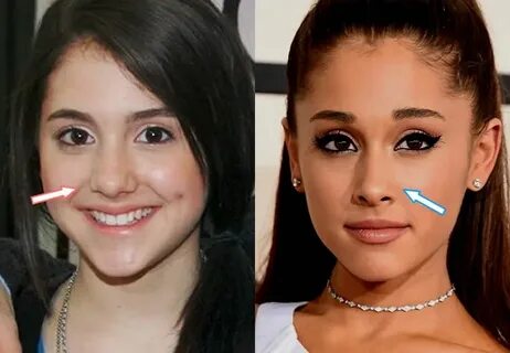 Ariana Grande - rhinoplasty - before and after Ariana grande