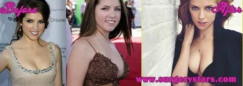 Anna Kendrick Latest Plastic Surgery NEWS update! Anna Kendr