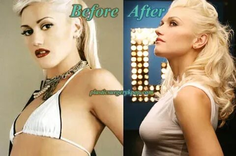 Gwen Stefani Plastic Surgery Before and After Pictures