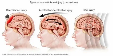 Concussion in Lehi - ReFlex Chiropractic