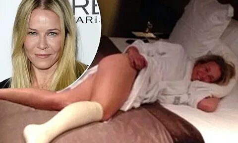 Chelsea Handler displays her leg bandaged and perfectly smoo