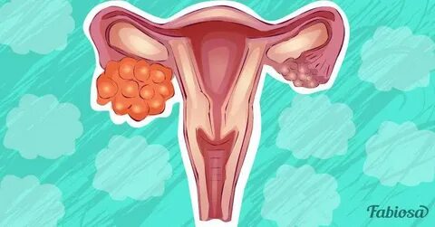 Can You Get Cervical Cancer During Menopause - Polyps - Wome