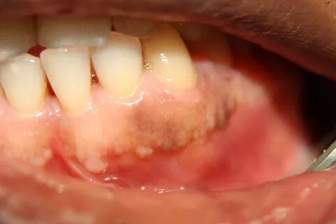 File:Pitmentierte Gingiva bei einem Schwarzafrikaner Zahn 33
