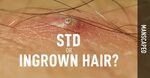 STD or Ingrown Hair?. It’s ok to love your penis. And your. 
