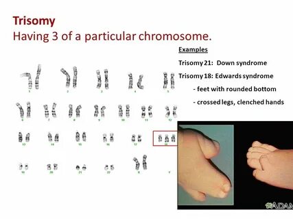18 хромосома синдром эдвардса фото: Трисомия 18: Синдром Эдв