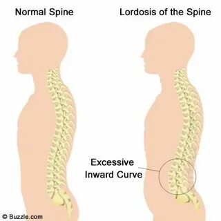 Lordosis Exercises Psoas release, Psoas muscle, Dance flexib