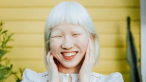 Asian albino girl