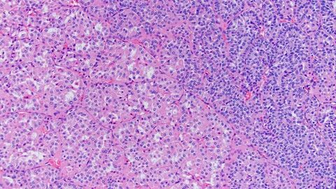 Clear Cell Sarcoma Kidney Pathology Outlines : Pathology Out