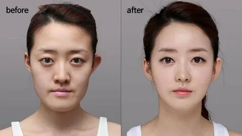 Korean Best ''Jaw surgery'' real story before and after - Yo