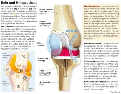 Künstliches Kniegelenk: Ersatz aus Titan Gesundheitsberater 