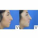 Make Your Features More Prominent With Best Rhinoplasty Bost
