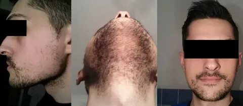 Nofap and hair regrowth NoFAP UNBELIEVABLE HAIR REGROWTH! : 