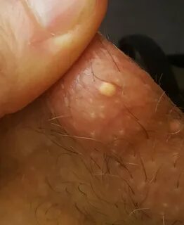 Bumps on scrotum sack Causes of Pimples on Balls, Bumps on S