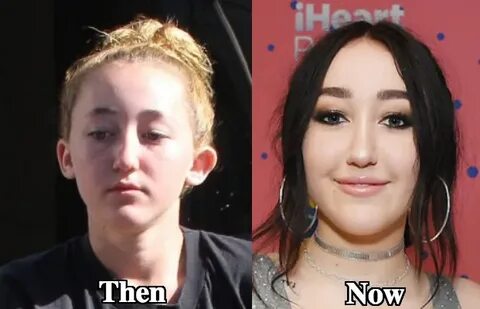 Noah Cyrus botox before and after - Latest Plastic Surgery G
