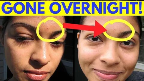 Reduce Pimple Inflammation Overnight! - YouTube