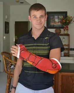 Creative Cast Art That Makes The Best Of A Bad Situation Arm