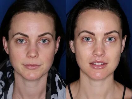 🥇 Atlanta Facial Cosmetic Surgery Before and After Photos Be