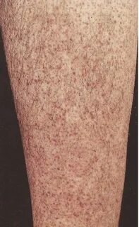 Moretones en las piernas: causas y síntomas
