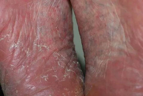 Fußpilz (Tinea pedis) - Ursachen & Therapie derma.plus