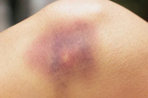 Bluterguss: Wann sind blaue Flecken gefährlich? - Heilpraxis