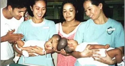 Siamese Twins Separated - CBS News