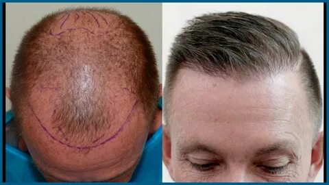 Hair transplant planning. Article