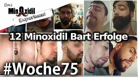 Minoxidil Bart Vorher Nachher - Quotes Trending
