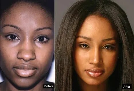 NOSE JOB Nose job, Plastic surgery, Rhinoplasty