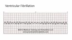 Ventricular Fibrillation - YouTube
