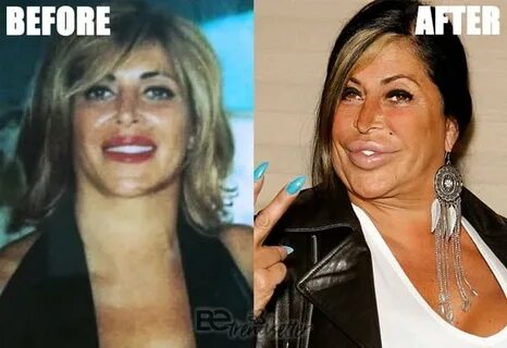 Plastic Surgery Gone Wrong 31 Worst Celebrity Before And Aft