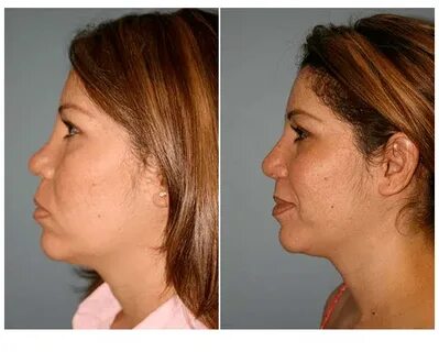 Revision Rhinoplasty San Diego Nose Job San Diego Nose Job L