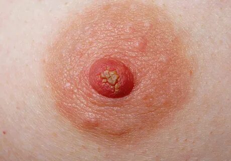 Close-up Of Woman's Nipple Showing A Discharge Photograph by