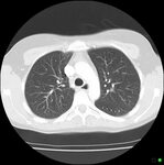 Normal chest CT (lung window) Radiology Case Radiopaedia.org