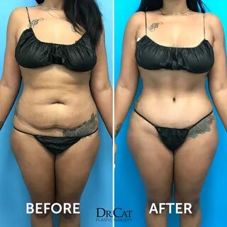 When Dr. Cat performs tummy tuck surgery, she takes into consideration all ...