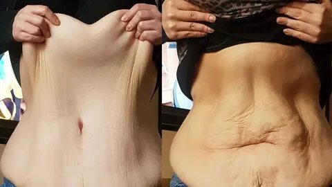 Loose Skin After Weight Loss- Learn how to tighten it