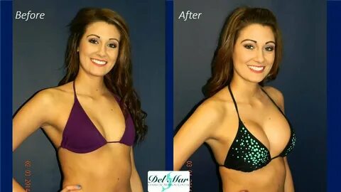 Breast Implants Before and After San Diego 858-350-8400 - Yo