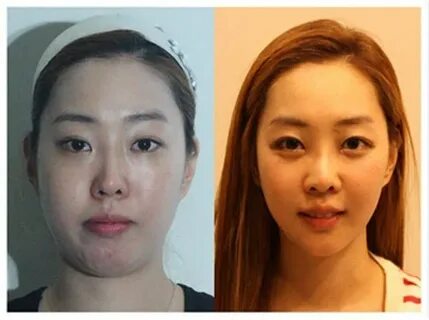 South Korea plastic surgery before and after photos Combinat