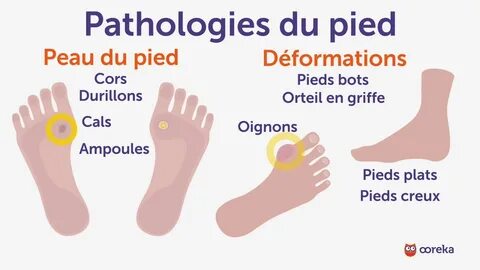 Soigner les pathologies du pied - Ooreka.fr - YouTube