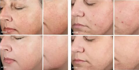 Get 41+ Image Skincare Before And After Photos