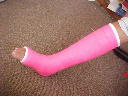 Mariah's Pink cast,my broken leg,Mariah sports hot pink ca. 