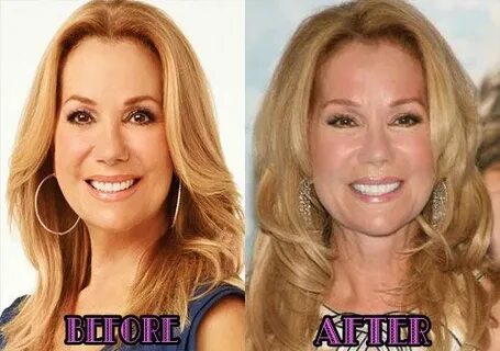 What Do These Kathy Lee Gifford Plastic Surgery Photos Tell 