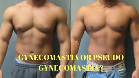...Gynecomastia involves buildup of breasts tissue, while pseudo-gynecomast...