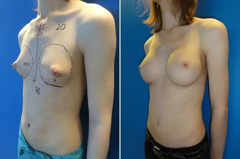 Breast implants - Mtf before and after BFS - 2pass Clinic